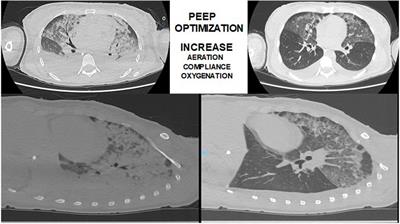 Thoracic Computed Tomography to Assess ARDS and COVID-19 Lungs